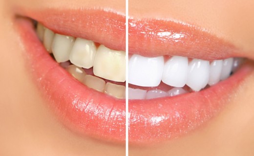 O que são lentes de contato dentais?